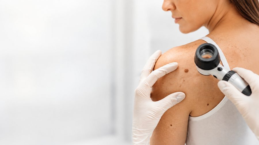 GP using a dermatoscope to examine a mole during a skin check at Hoppers Lane General Practice